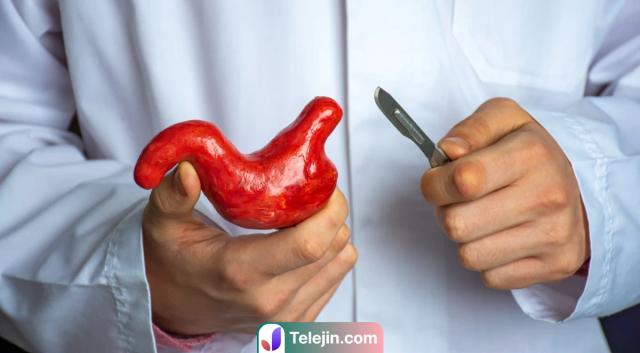 اسلیو معده