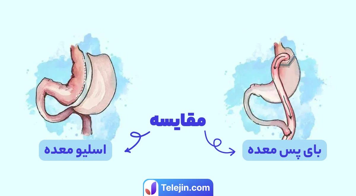 مقایسه اسلیو معده و بای پس معده