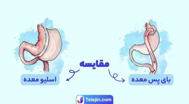 مقایسه اسلیو معده و بای پس معده